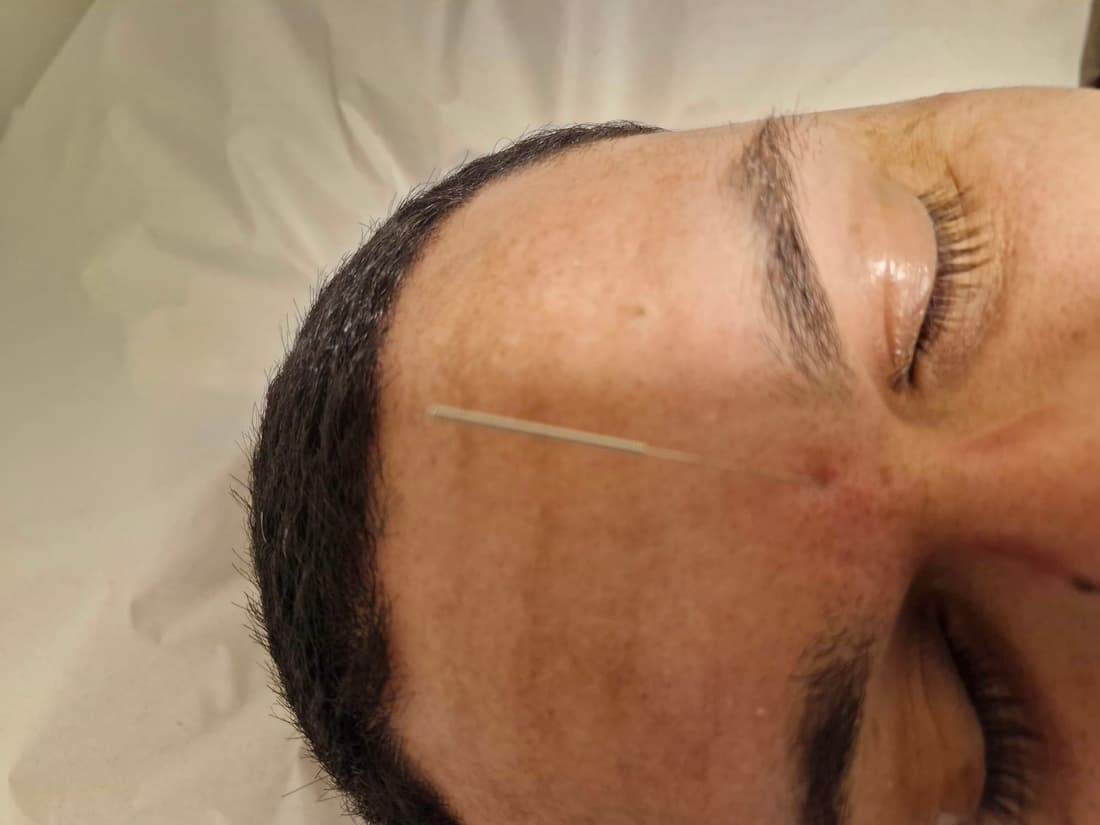 Sessão de acupuntura no Yoga du Ville — agulha no ponto Yintang, Tijuca